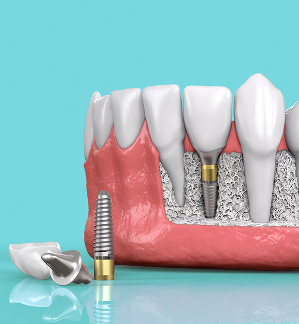 tooth implants balwyn north